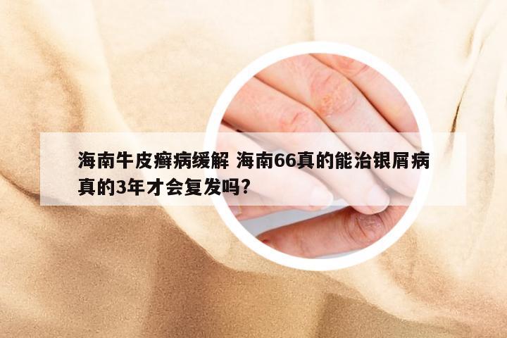 海南牛皮癣病缓解 海南66真的能治银屑病真的3年才会复发吗?