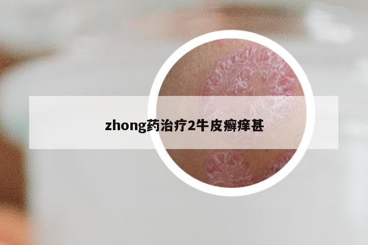 zhong药治疗2牛皮癣痒甚