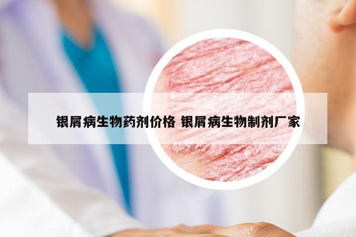 银屑病生物药剂价格 银屑病生物制剂厂家