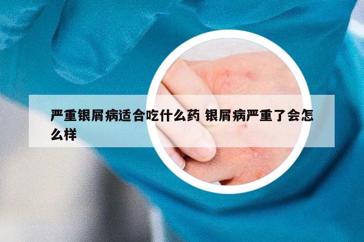 严重银屑病适合吃什么药 银屑病严重了会怎么样