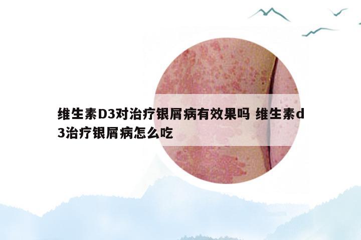 维生素D3对治疗银屑病有效果吗 维生素d3治疗银屑病怎么吃