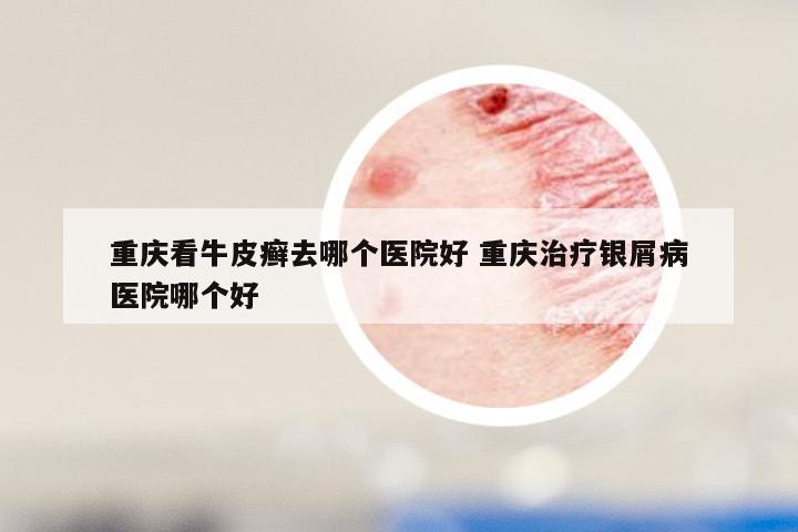 重庆看牛皮癣去哪个医院好 重庆治疗银屑病医院哪个好