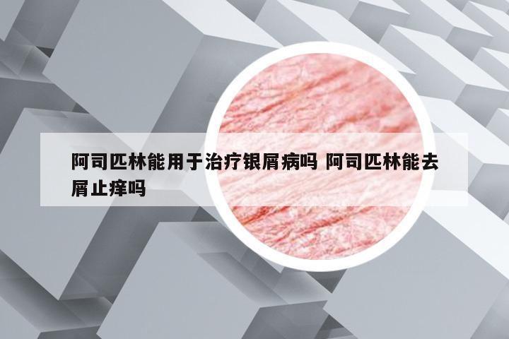 阿司匹林能用于治疗银屑病吗 阿司匹林能去屑止痒吗