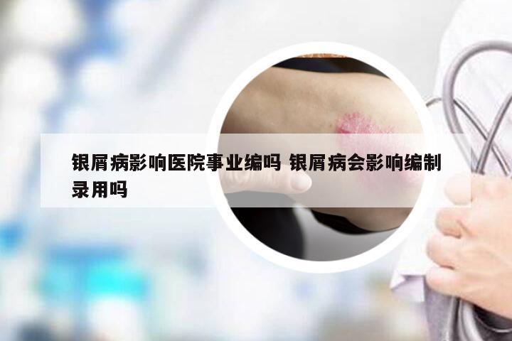 银屑病影响医院事业编吗 银屑病会影响编制录用吗