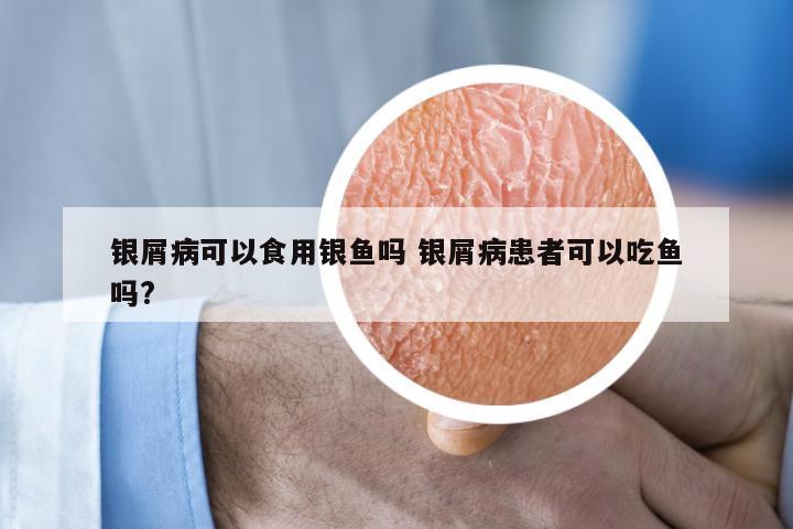 银屑病可以食用银鱼吗 银屑病患者可以吃鱼吗?