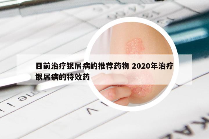 目前治疗银屑病的推荐药物 2020年治疗银屑病的特效药