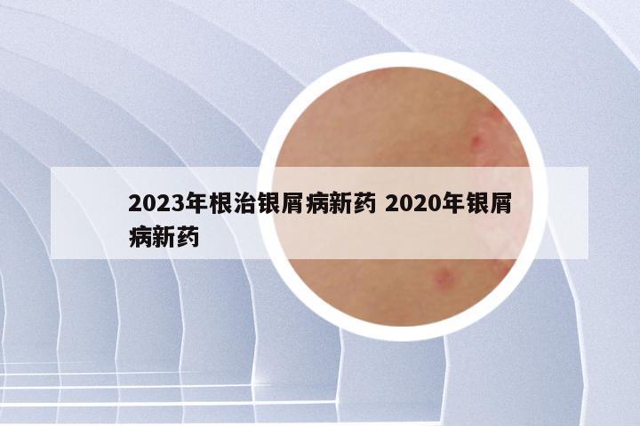 2023年根治银屑病新药 2020年银屑病新药