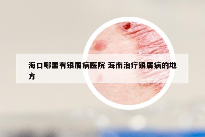 海口哪里有银屑病医院 海南治疗银屑病的地方