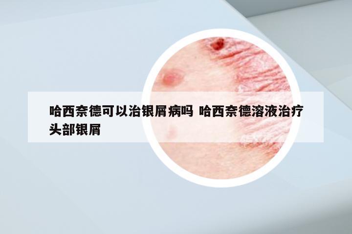 哈西奈德可以治银屑病吗 哈西奈德溶液治疗头部银屑