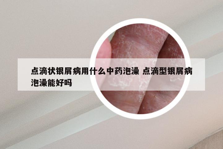 点滴状银屑病用什么中药泡澡 点滴型银屑病泡澡能好吗