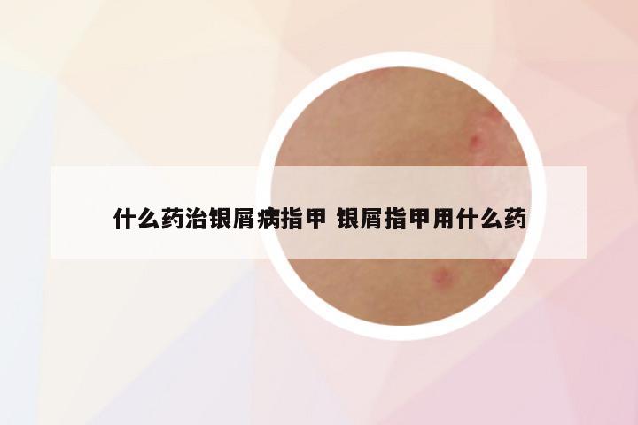 什么药治银屑病指甲 银屑指甲用什么药