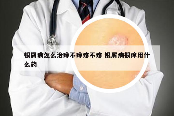 银屑病怎么治痒不痒疼不疼 银屑病很痒用什么药