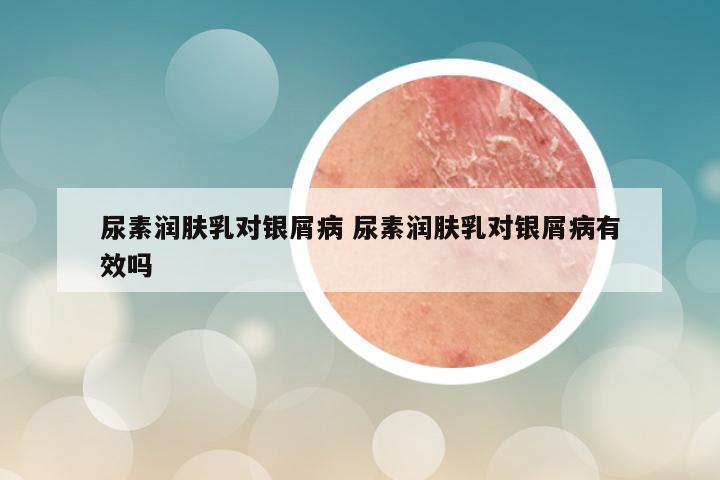 尿素润肤乳对银屑病 尿素润肤乳对银屑病有效吗