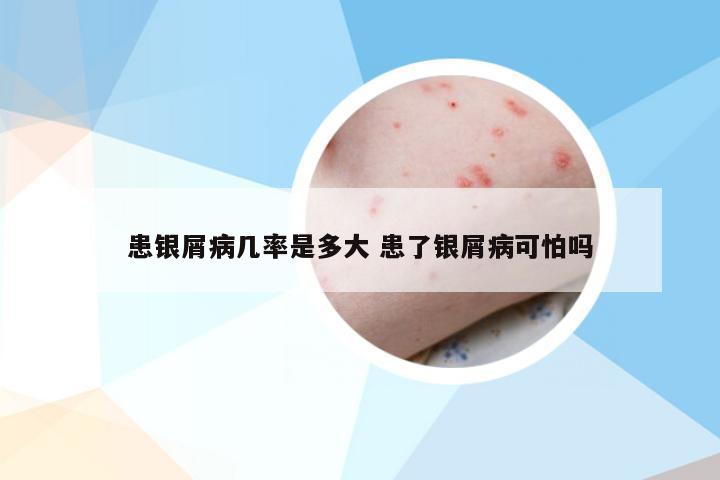 患银屑病几率是多大 患了银屑病可怕吗