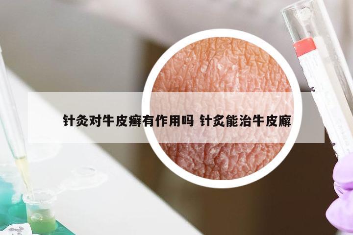 针灸对牛皮癣有作用吗 针炙能治牛皮廨