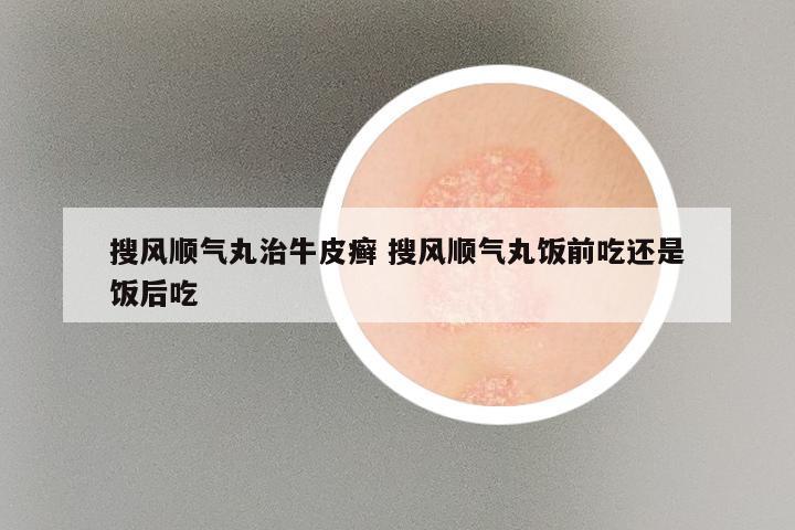 搜风顺气丸治牛皮癣 搜风顺气丸饭前吃还是饭后吃