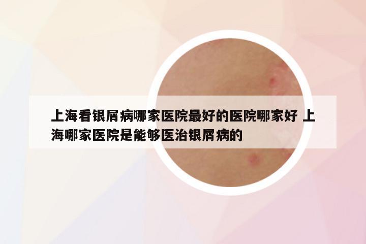 上海看银屑病哪家医院最好的医院哪家好 上海哪家医院是能够医治银屑病的