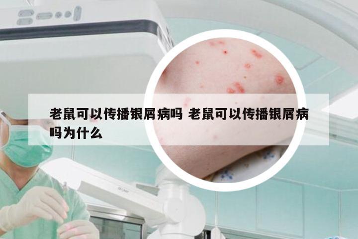 老鼠可以传播银屑病吗 老鼠可以传播银屑病吗为什么