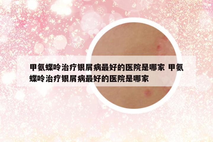 甲氨蝶呤治疗银屑病最好的医院是哪家 甲氨蝶呤治疗银屑病最好的医院是哪家