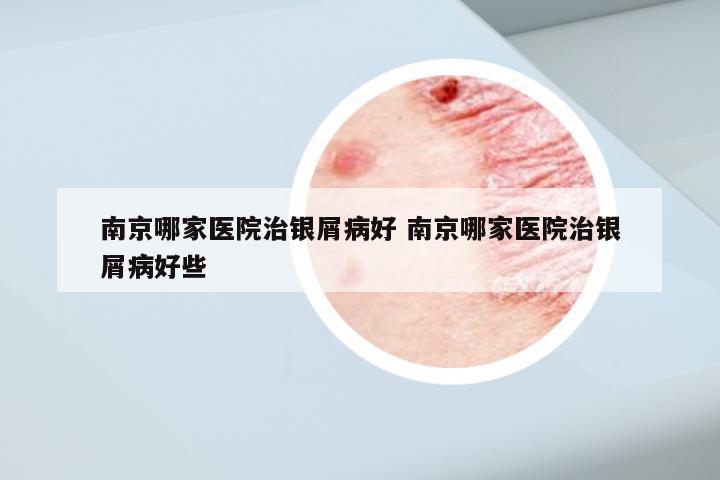 南京哪家医院治银屑病好 南京哪家医院治银屑病好些