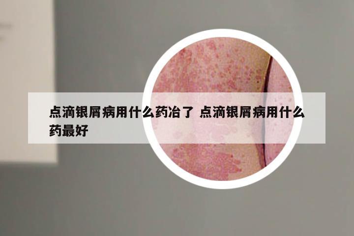 点滴银屑病用什么药冶了 点滴银屑病用什么药最好