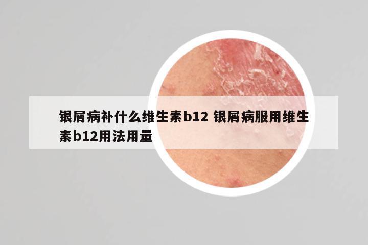 银屑病补什么维生素b12 银屑病服用维生素b12用法用量