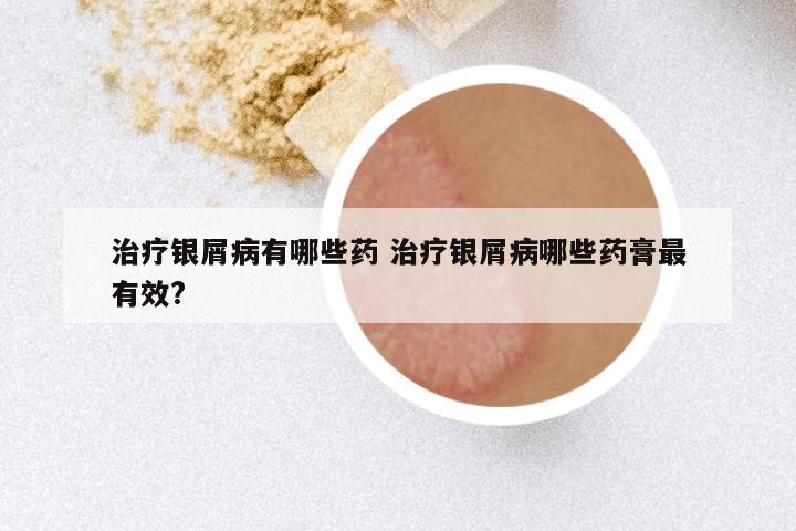 治疗银屑病有哪些药 治疗银屑病哪些药膏最有效?