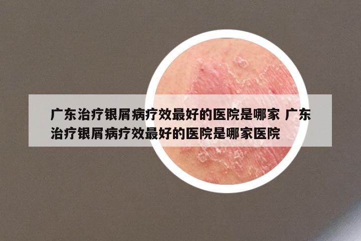 广东治疗银屑病疗效最好的医院是哪家 广东治疗银屑病疗效最好的医院是哪家医院