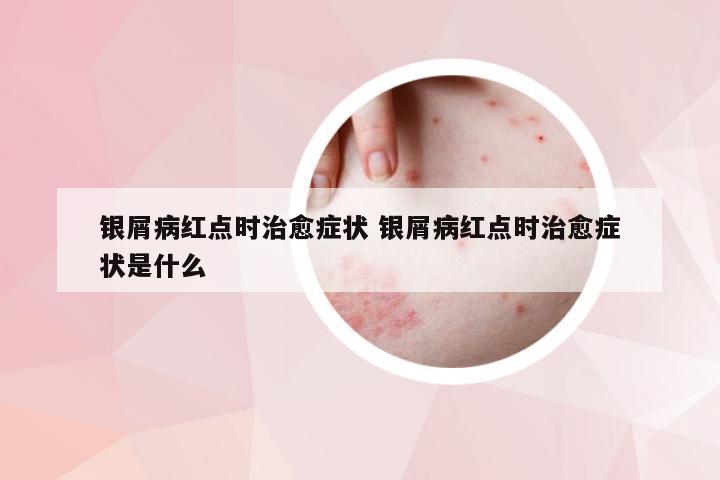 银屑病红点时治愈症状 银屑病红点时治愈症状是什么