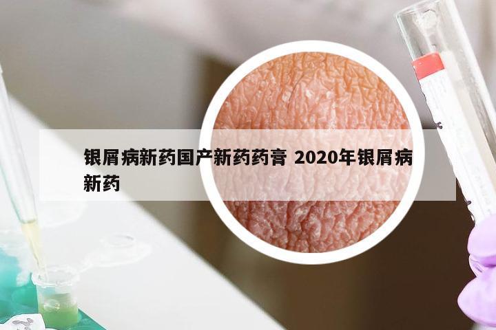 银屑病新药国产新药药膏 2020年银屑病新药