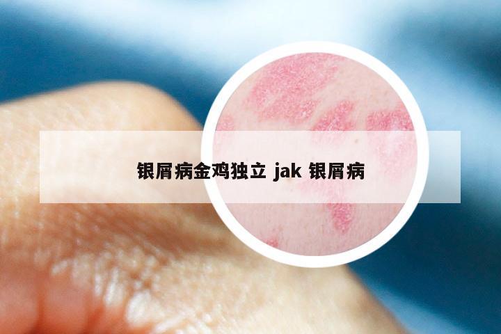 银屑病金鸡独立 jak 银屑病