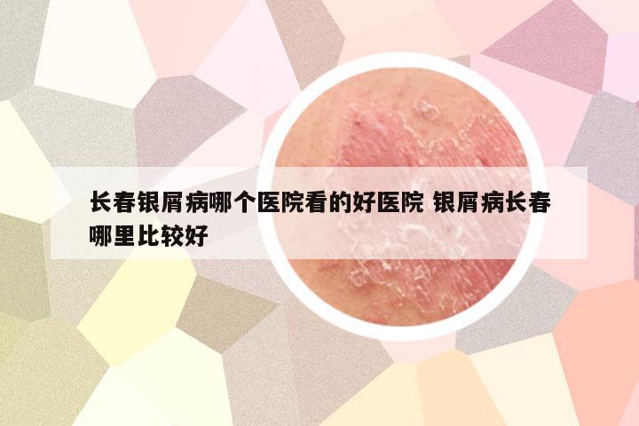 长春银屑病哪个医院看的好医院 银屑病长春哪里比较好