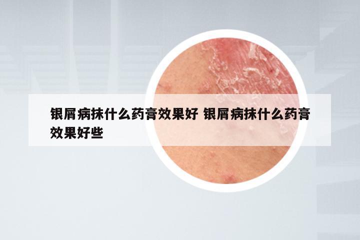 银屑病抹什么药膏效果好 银屑病抹什么药膏效果好些