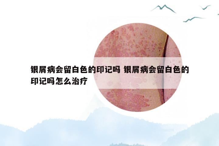 银屑病会留白色的印记吗 银屑病会留白色的印记吗怎么治疗