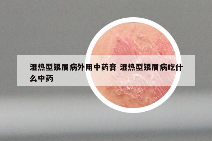 湿热型银屑病外用中药膏 湿热型银屑病吃什么中药