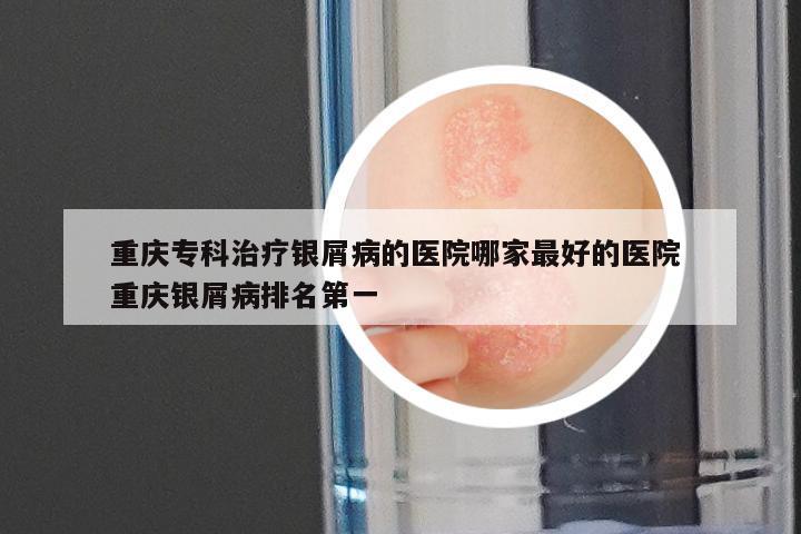 重庆专科治疗银屑病的医院哪家最好的医院 重庆银屑病排名第一