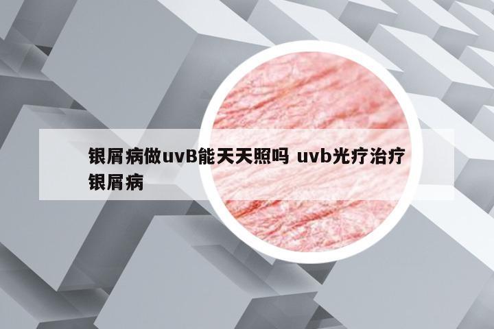 银屑病做uvB能天天照吗 uvb光疗治疗银屑病