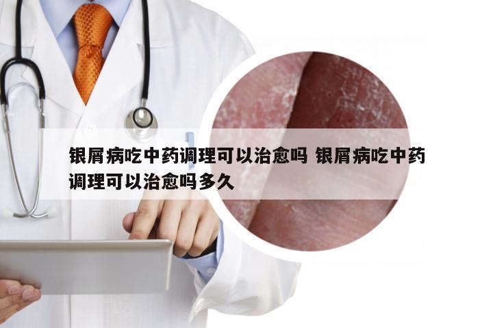 银屑病吃中药调理可以治愈吗 银屑病吃中药调理可以治愈吗多久