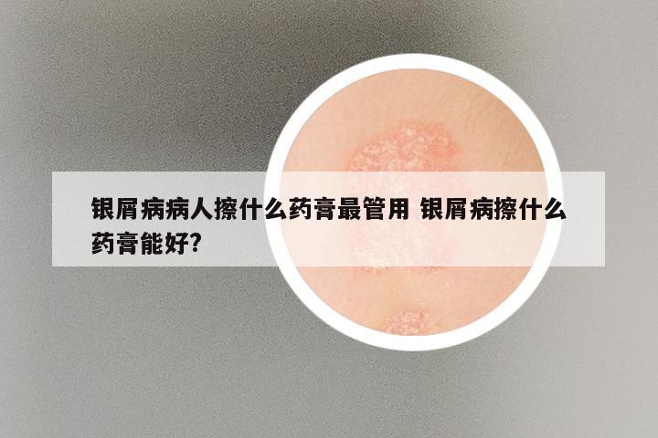 银屑病病人擦什么药膏最管用 银屑病擦什么药膏能好?