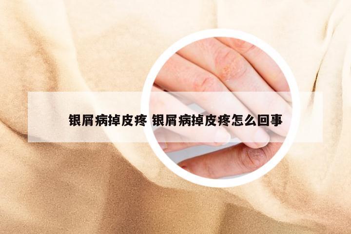 银屑病掉皮疼 银屑病掉皮疼怎么回事