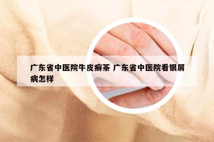 广东省中医院牛皮癣茶 广东省中医院看银屑病怎样