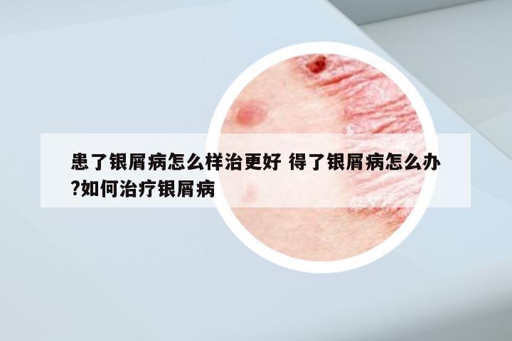 患了银屑病怎么样治更好 得了银屑病怎么办?如何治疗银屑病