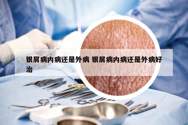 银屑病内病还是外病 银屑病内病还是外病好治