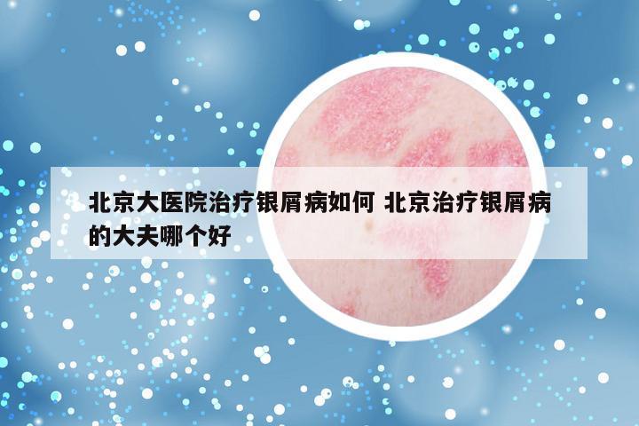 北京大医院治疗银屑病如何 北京治疗银屑病的大夫哪个好