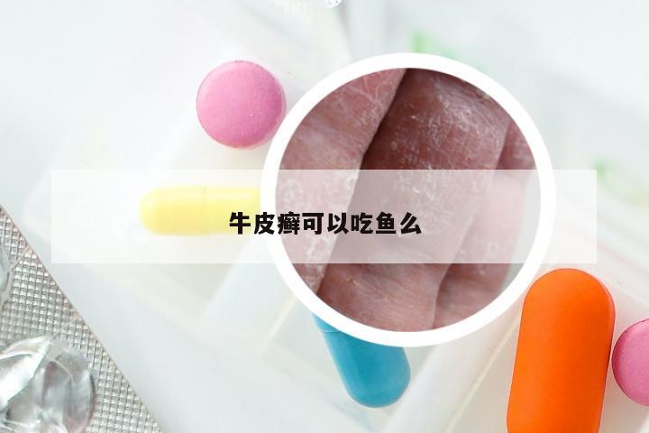 牛皮癣可以吃鱼么