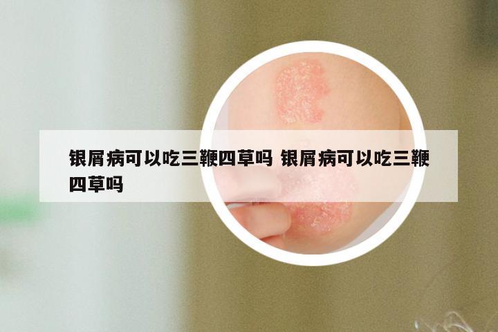 银屑病可以吃三鞭四草吗 银屑病可以吃三鞭四草吗