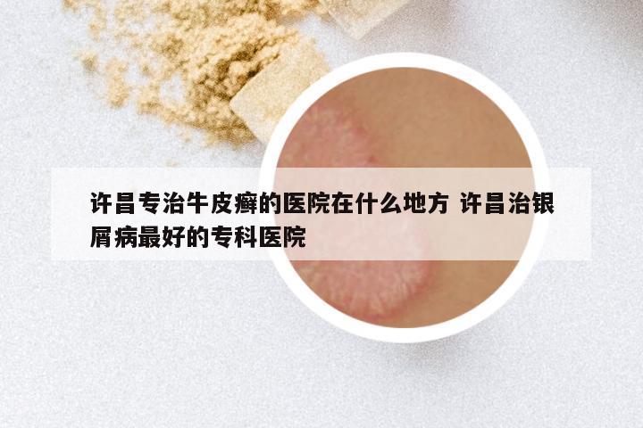 许昌专治牛皮癣的医院在什么地方 许昌治银屑病最好的专科医院