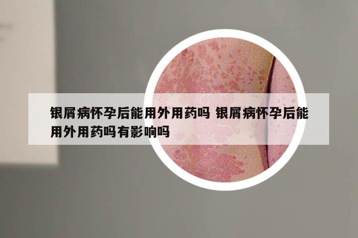 银屑病怀孕后能用外用药吗 银屑病怀孕后能用外用药吗有影响吗