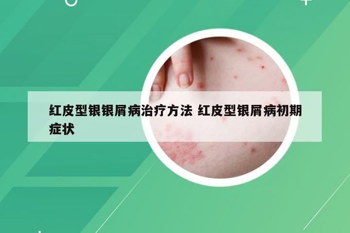 红皮型银银屑病治疗方法 红皮型银屑病初期症状