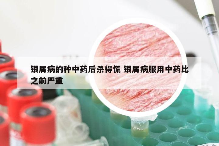 银屑病的种中药后杀得慌 银屑病服用中药比之前严重